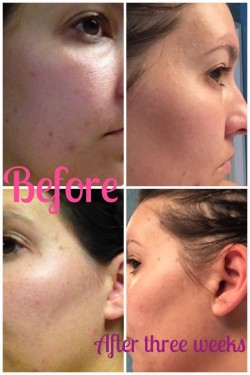 Rodan + Fields: My personal before and after using Unblemish, 2014 Copyright Christine Hull, Windy Pinwheel rodan and fields giveaway